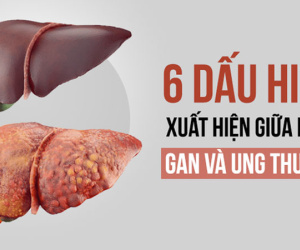 6 dấu hiệu cảnh báo khi bệnh gan tiến triển thành ung thư: Phát hiện sớm là rất quan trọng