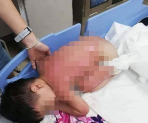 Cùng mẹ chơi dưới bếp, bé trai 2 tuổi bị bỏng nặng khi mặt bếp bất ngờ phát nổ, lời cảnh báo đáng sợ dành cho các phụ huynh