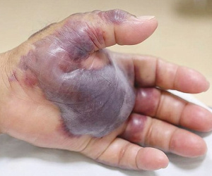 Bị cắt cụt tay chỉ vì ăn món khoái khẩu này: Chuyên gia cảnh báo một thói quen ăn uống dễ dẫn đến cái kết đắng!