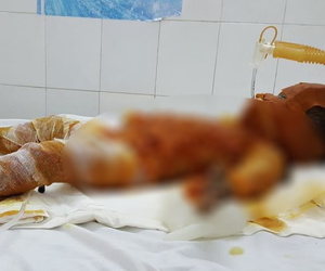 Sóc Trăng: Bố mẹ vắng nhà, 3 chị em chơi đốt rác khiến bé gái 20 tháng tuổi bỏng nặng đến 90%