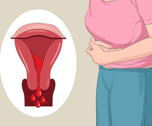Lạc nội mạc tử cung và 6 dấu hiệu điển hình của căn bệnh này mà con gái không nên chủ quan bỏ qua