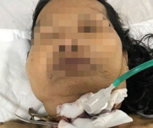Ngã trúng nơi cháu nội đang mổ gà ăn lễ 2/9, cụ bà 73 tuổi bị dao đâm xuyên cổ