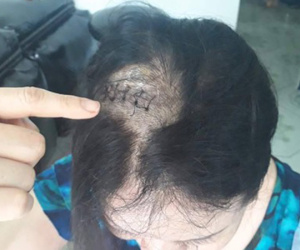 Đèn sân khấu rơi trúng đầu, bệnh viện chẩn đoán tai nạn giao thông