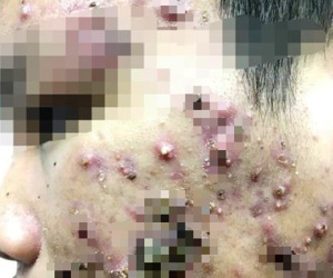 Hãi hùng mặt lở loét, mọc đầy lông vì dùng kem trộn chữa trứng cá, nám má