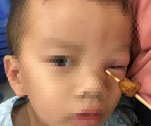 Vấp ngã khi chạy phụ cha đẩy xe, bé trai 4 tuổi bị xiên cá viên đâm sâu vào hốc mắt