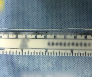 Trung Quốc: Sán dây dài 10 cm chui vào não thanh niên mê đồ nướng
