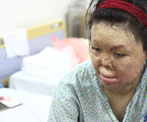 Sau 1 năm và hàng chục cuộc phẫu thuật, người vợ Hà Nội bị chồng thiêu hôm mùng 2 Tết, chỉ có 1% cơ hội sống sót đã 'hồi sinh'