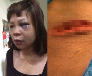 Vì ghen tuông, nữ hộ lý bị chồng dụ lên đồi đánh đập dã man, cắt gân chân