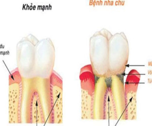 Đánh răng sai cách là nguyên nhân gây ra nhiều bệnh ung thư