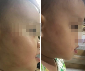 Chủ tịch Hà Nội yêu cầu xác minh vụ phụ huynh 'tố' bé 20 tháng bị đánh ở lớp