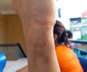 Thường xuyên trồng, chăm hoa, người phụ nữ hốt hoảng vì ho ra đờm toàn sinh vật lạ
