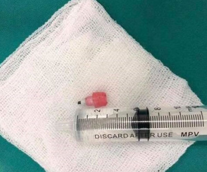 Bé gái 6 tuổi nguy kịch vì nuốt đầu mẩu bút chì