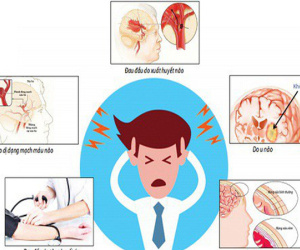 Nhận diện những cơn đau đầu nguy hiểm