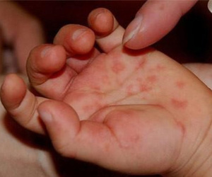 Bệnh tay chân miệng: Biến chứng gây tử vong ở trẻ em cha mẹ không thể bỏ qua