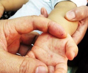 Để trẻ không tử vong khi mắc tay chân miệng, Bộ Y tế khuyến cáo 6 điều phải làm ngay