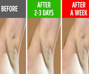 Đừng cố tình bỏ qua 6 biểu hiện ở nách vì nó có thể chỉ ra bệnh tiềm ẩn, không ngoại trừ ung thư