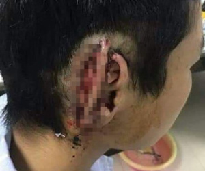 Công an vào cuộc vụ nam sinh cắn đứt tai bạn rồi nuốt luôn vào bụng