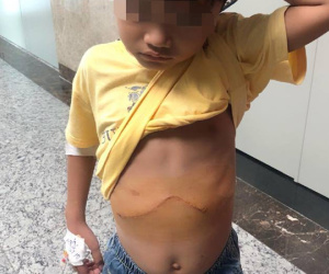 Bé trai 7 tuổi nôn ra đầy bát máu vì căn bệnh vô cùng hiểm ác