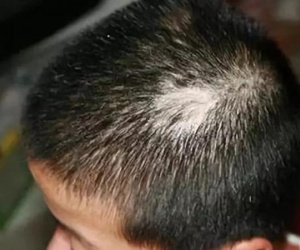 Con trai 3 tuổi đột nhiên bị rụng tóc, nguyên nhân thật sự khiến cha mẹ rất xấu hổ