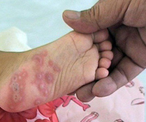 Tay chân miệng có thể biến chứng tử vong: BS bệnh viện Nhi khuyến cáo 4 việc cần làm ngay
