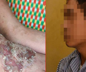 Thích ăn tiết canh, rau sống, nem chua, người đàn ông bị đau gan vì nguyên nhân không ngờ