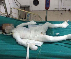 Bé trai 6 tuổi bị cha dượng ngáo đá đổ xăng đốt đến nguy kịch