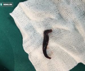 Sinh vật dài 5cm ngoe nguẩy trong mũi, khiến bệnh nhân đau đầu, sổ mũi kéo dài