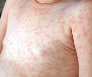 Thấy con bị sốt, nổi ban, mụn nước toàn thân, cha mẹ cần nghĩ ngay đến bệnh này