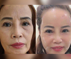 Sau khi đưa chồng trẻ đi nhấn mí, cô dâu 62 tuổi lại gây sốc với gương mặt 'trẻ ra 20 tuổi' nhờ PTTM