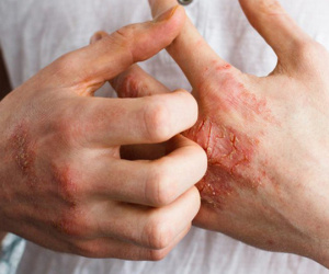 Tai họa đến từ cuộc sống hiện đại mang tên: Dị ứng thực phẩm
