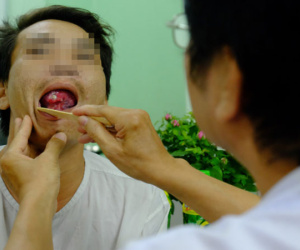 Từ 1 vết loét nhỏ trong miệng, chàng trai 19 tuổi bàng hoàng khi biết mình là bệnh nhân trẻ nhất bị ung thư lưỡi