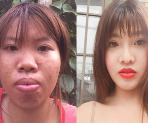 Phượng 'Thị Nở' bất ngờ bị ngã trầy xước mặt mũi sau gần 2 năm thẩm mỹ khiến nhiều người lo lắng