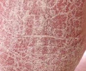 Hàng triệu người Việt mắc 'căn bệnh lạ' xù xì như cóc, nhiều người tuyệt vọng vì bị kỳ thị