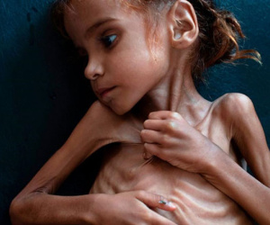 Bé gái da bọc xương gây chấn động thế giới về nạn đói ở Yemen qua đời