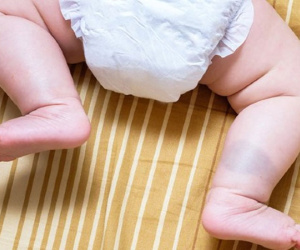 Trẻ bị chàm xanh: Những điều cha mẹ cần biết