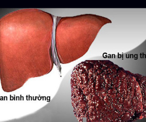 5 nguyên nhân khiến người Việt mắc và chết vì ung thư gan cao thứ 4 thế giới