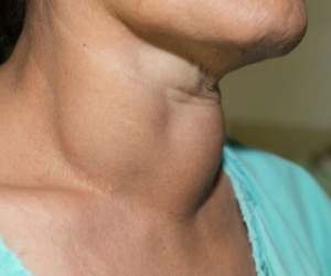 4 người cùng gia đình bị ung thư tuyến giáp, 6 dấu hiệu bệnh không được bỏ qua