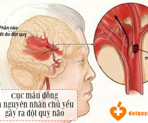 Nghiên cứu mới tiếp tục khẳng định vai trò tích cực của Nattospes với bệnh nhân nhồi máu não