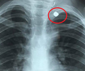Cha bất cẩn để súng săn có đạn, con trai bóp cò bắn xuyên phổi em
