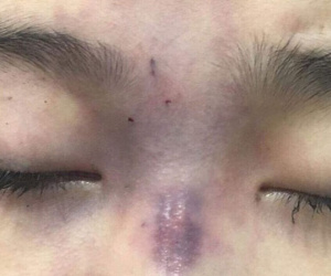 Chồng sắp cưới mua filler tiêm nâng mũi cho vợ khiến cô gái bị mù vĩnh viễn