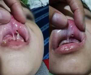Hình ảnh kinh hoàng trong miệng đứa trẻ và lời cảnh báo đầy sức nặng dành cho cha mẹ