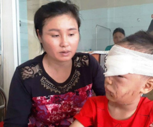 Bé trai 6 tuổi ở Thanh Hóa bị chó nhà cắn rách mặt