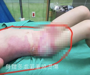 Con gái 5 tuổi bị bỏng nặng, kiểm tra camera trong trường mẫu giáo bố mẹ càng phẫn nộ hơn