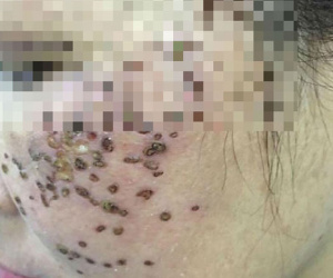 Chi cả trăm triệu làm đẹp mặt vẫn biến dạng, nhiều quý bà phải 'cầu cứu' bác sĩ