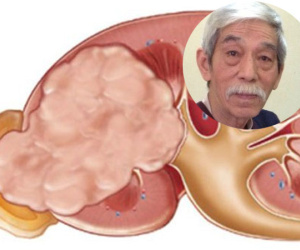 Những điều ít biết về căn bệnh ung thư thận diễn viên Ngọc Căn mắc phải