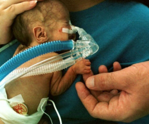 Nhiễm độc sữa mẹ được hút ra từ máy hút sữa, bé sơ sinh mắc bệnh viêm màng não hiếm gặp