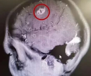Bác sĩ lôi ký sinh trùng 15cm trong não bé trai, cảnh báo thói quen xấu khi ăn uống