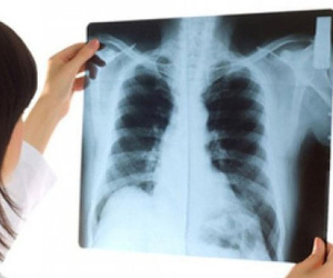 Dấu hiệu sớm căn bệnh 'sát thủ' làm 21.000 người Việt Nam chết mỗi năm