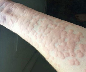 Cô gái nổi tiếng vì 'dị ứng mùa đông', bác sĩ lắc đầu trước bệnh hiếm