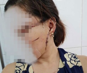 Gã chồng cắt gân chân vợ do ghen tuông lĩnh 27 tháng tù